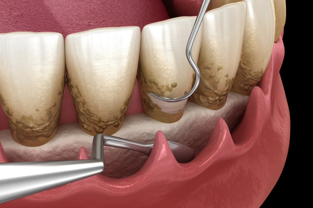 chirurgie assainissement parodontal chirurgie assainissement parodontal Soins des gencives chirurgicaux Dr Johan Cinçon - Chirurgien-dentiste à La Teste-de-Buch
